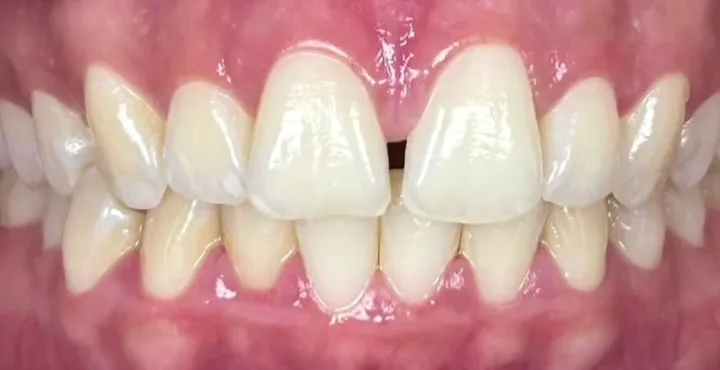 Dentes da paciente hoje, com espaço entre os da frente