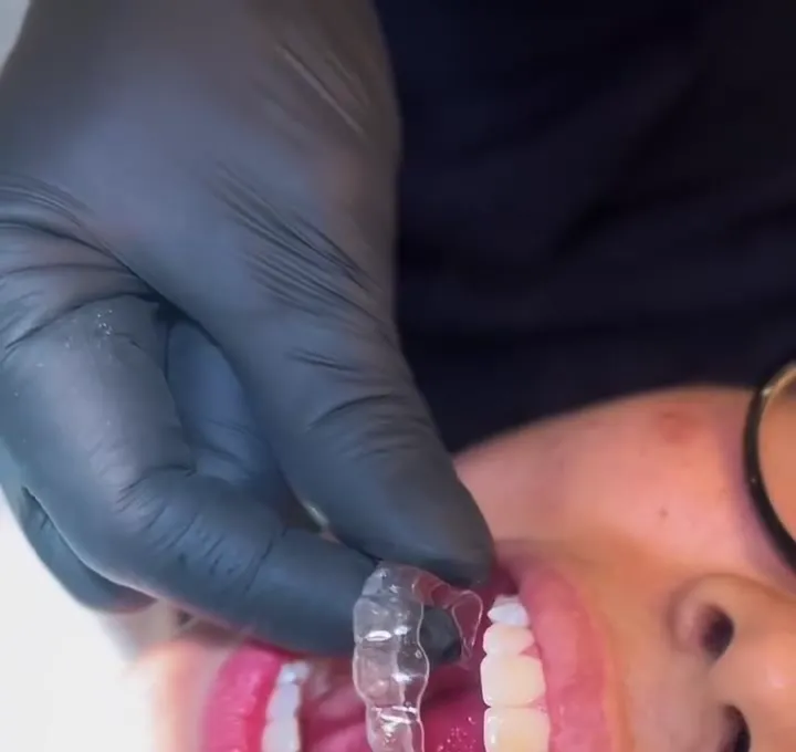 Dentista colocando alinhador transparente na paciente