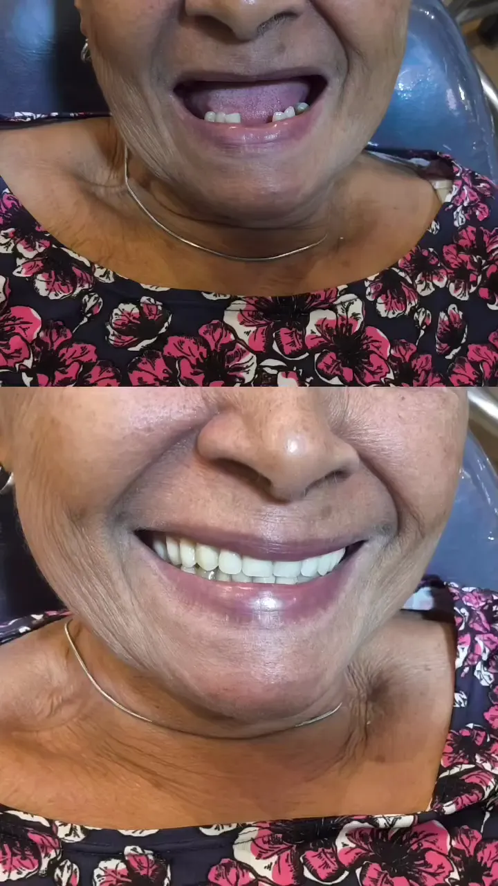Paciente da clínica antes e depois da prótese protocolo, agora sorrindo com dentes completos