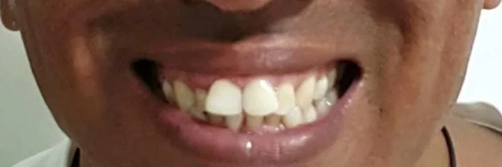 Sorriso do paciente antes do tratamento
