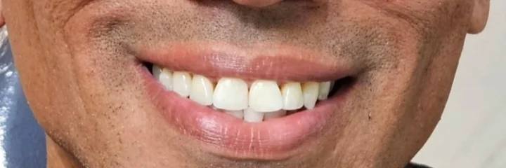 Sorriso do paciente depois do tratamento na Odonto Dias