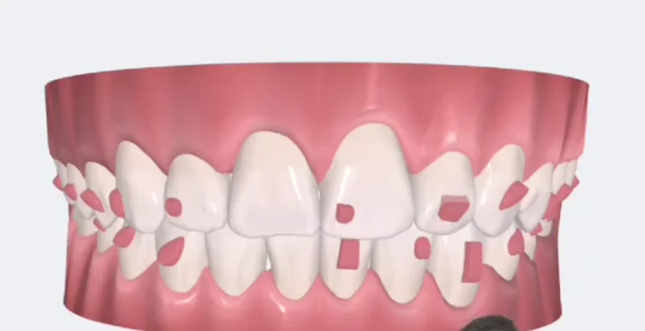 Simulação 3D dos dentes alinhados ao fim do tratamento